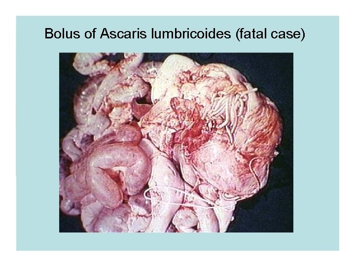 Bolus of Ascaris lumbricoides (fatal case) Bolus of Ascaris lumbricoides (fatal case)