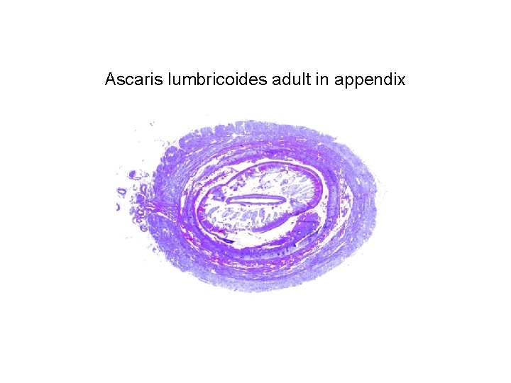 Ascaris lumbricoides adult in appendix Ascaris lumbricoides adult in appendix