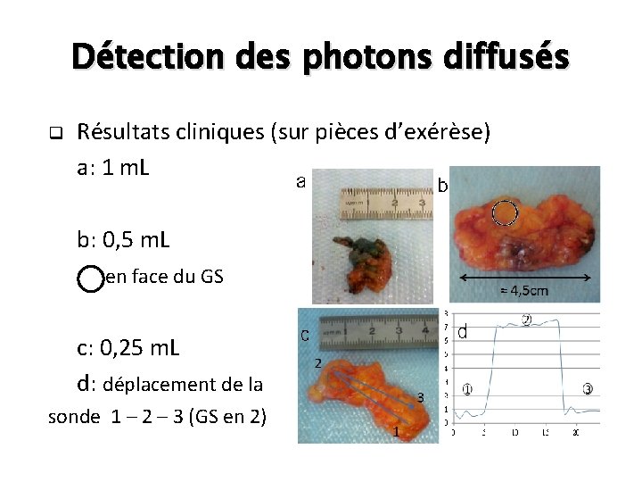 Détection des photons diffusés q Résultats cliniques (sur pièces d’exérèse) a: 1 m. L