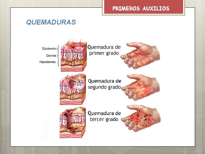 PRIMEROS AUXILIOS QUEMADURAS 