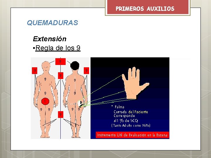 PRIMEROS AUXILIOS QUEMADURAS Extensión • Regla de los 9 