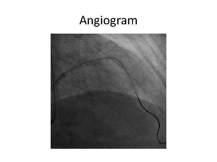 Successful Stent Ablation of Underexpanded Stent with Rotational
