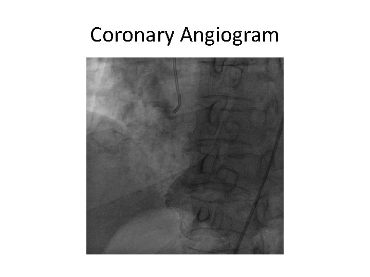 Successful Stent Ablation of Underexpanded Stent with Rotational