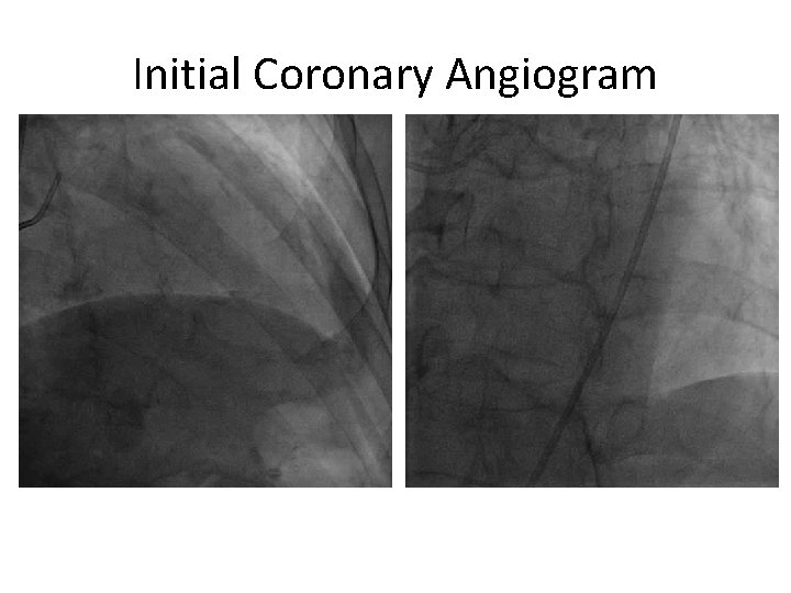 Successful Stent Ablation of Underexpanded Stent with Rotational