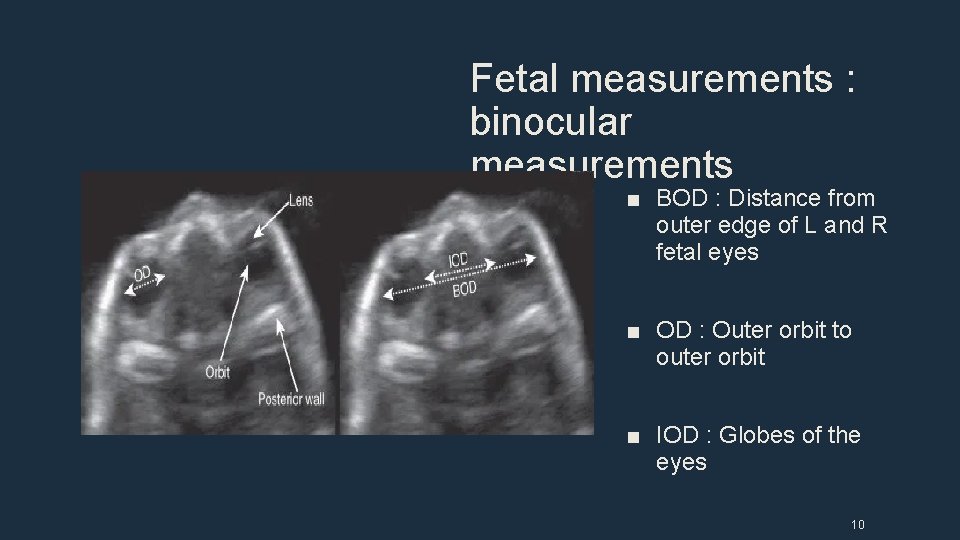Fetal measurements : binocular measurements ■ BOD : Distance from outer edge of L