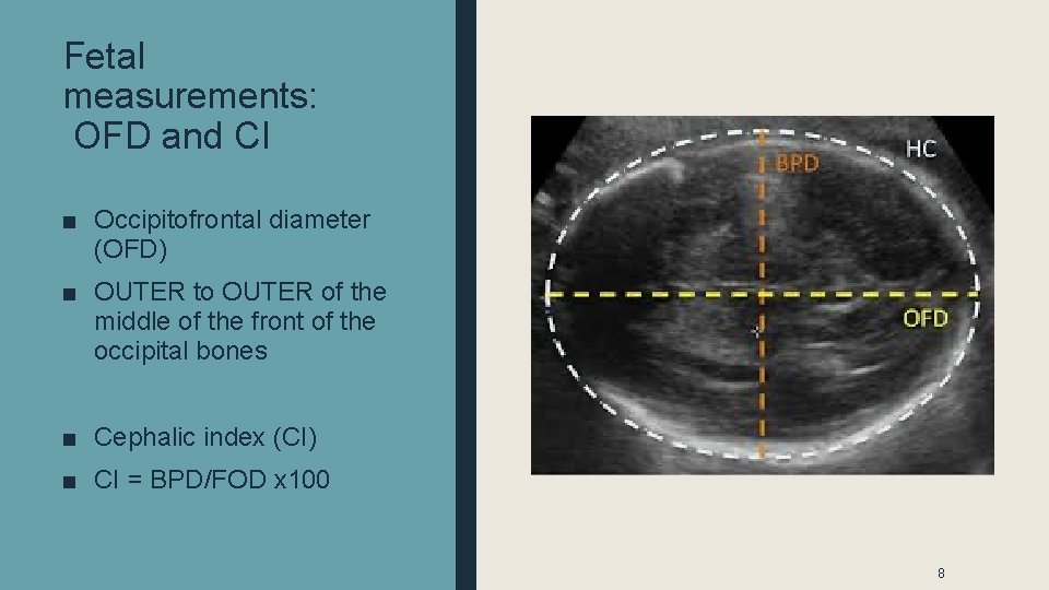 Fetal measurements: OFD and CI ■ Occipitofrontal diameter (OFD) ■ OUTER to OUTER of