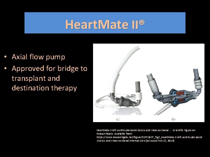 Heart. Mate II® • Axial flow pump • Approved for bridge to transplant and