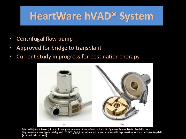 Heart. Ware h. VAD® System • Centrifugal flow pump • Approved for bridge to