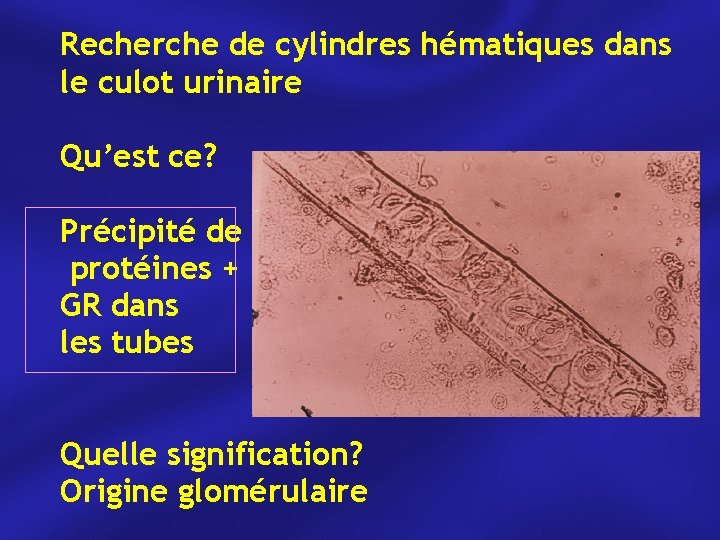 Recherche de cylindres hématiques dans le culot urinaire Qu’est ce? Précipité de protéines +