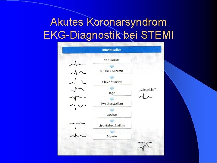 Akutes Koronarsyndrom EKG-Diagnostik bei STEMI Akutes Koronarsyndrom EKG-Diagnostik bei STEMI