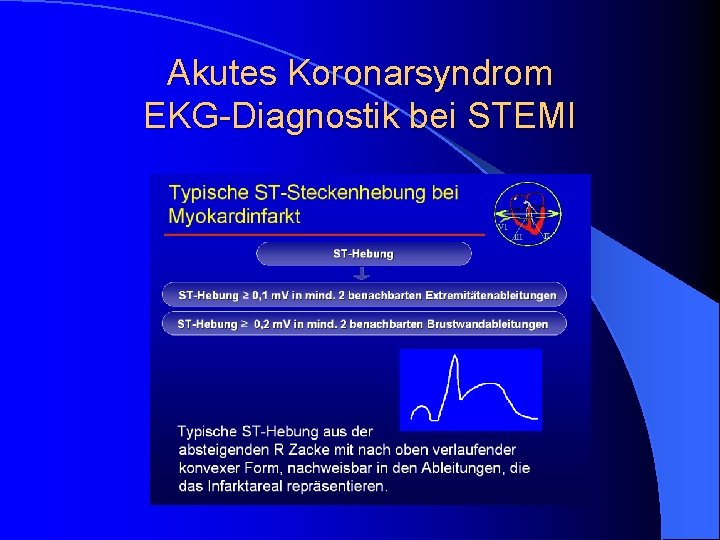 Akutes Koronarsyndrom EKG-Diagnostik bei STEMI Akutes Koronarsyndrom EKG-Diagnostik bei STEMI