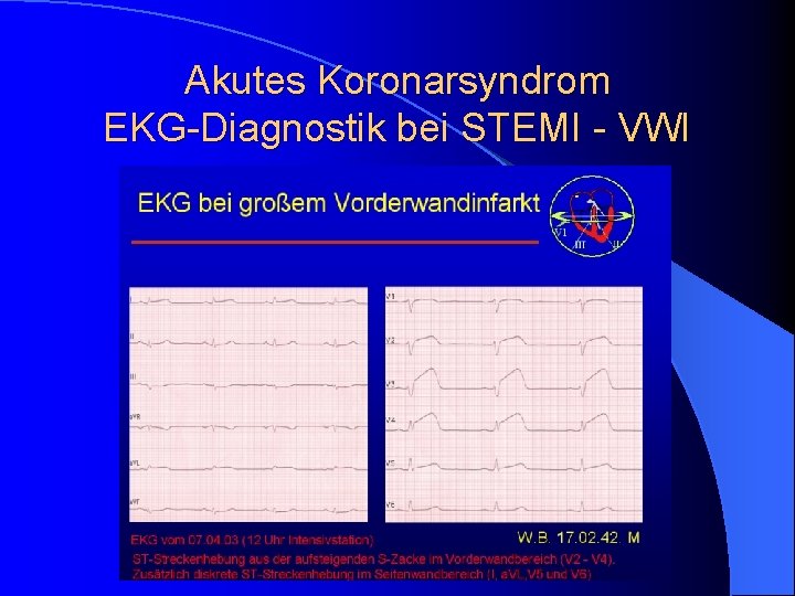 Akutes Koronarsyndrom EKG-Diagnostik bei STEMI - VWI Akutes Koronarsyndrom EKG-Diagnostik bei STEMI - VWI