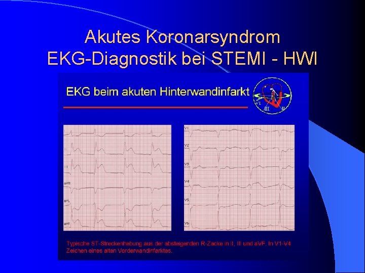 Akutes Koronarsyndrom EKG-Diagnostik bei STEMI - HWI Akutes Koronarsyndrom EKG-Diagnostik bei STEMI - HWI