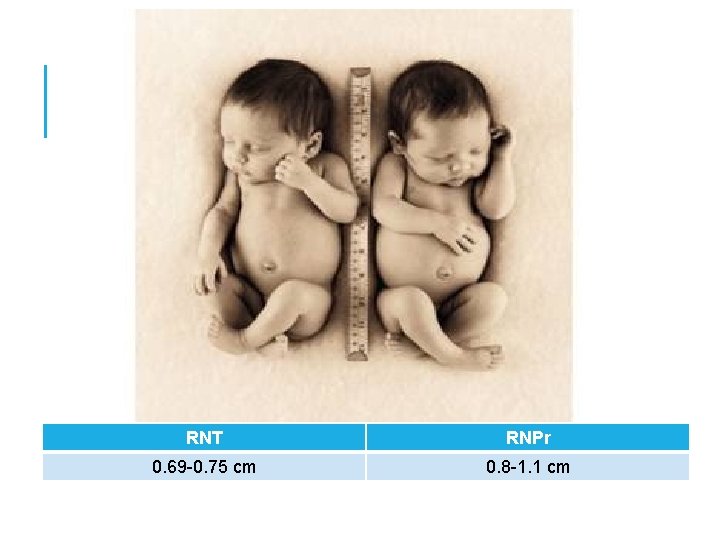 RNT RNPr 0. 69 -0. 75 cm 0. 8 -1. 1 cm RNT RNPr 0. 69 -0. 75 cm 0. 8 -1. 1 cm