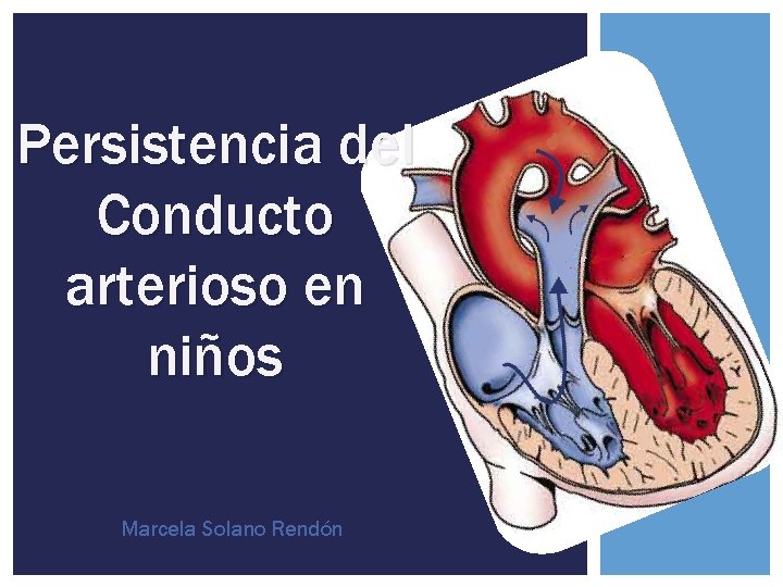 Persistencia del Conducto arterioso en niños Marcela Solano Rendón 