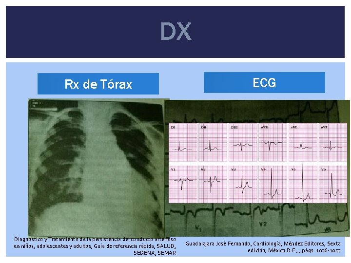 DX Rx de Tórax Diagnóstico y Tratamiento de la persistencia del conducto arterioso en