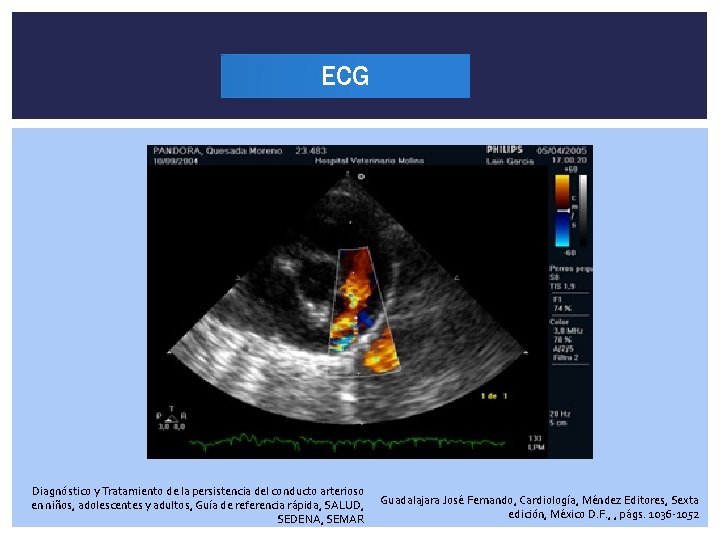 ECG Diagnóstico y Tratamiento de la persistencia del conducto arterioso en niños, adolescentes y