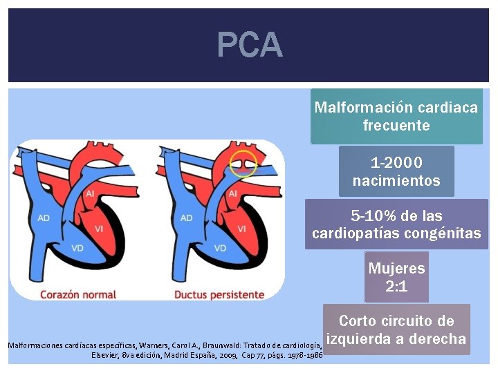 PCA Malformación cardiaca frecuente 1 -2000 nacimientos 5 -10% de las cardiopatías congénitas Mujeres