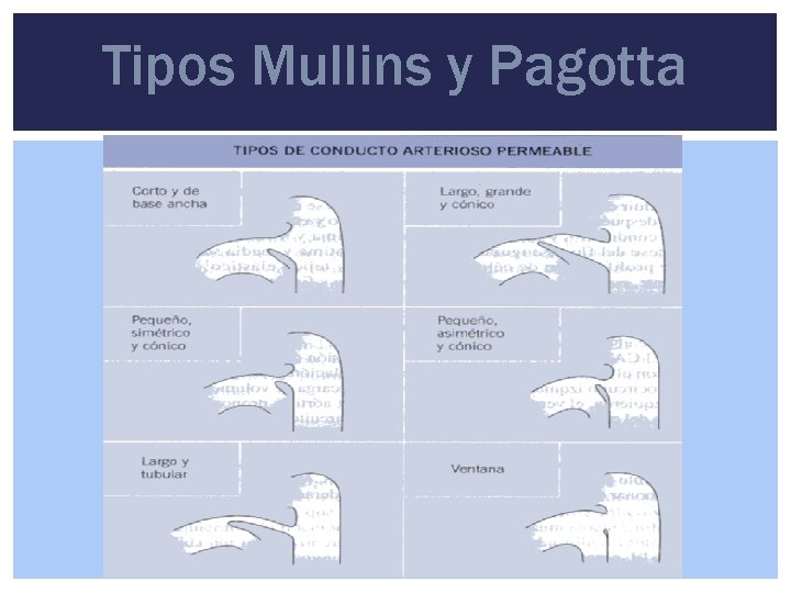 Tipos Mullins y Pagotta 