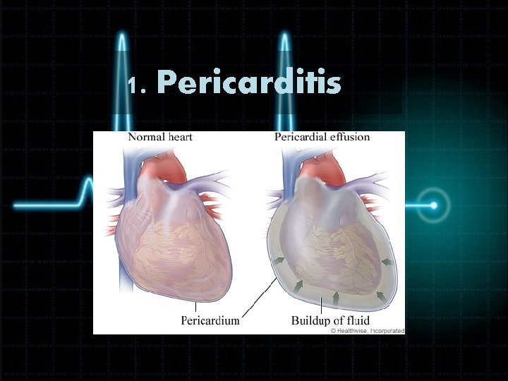 1. Pericarditis 