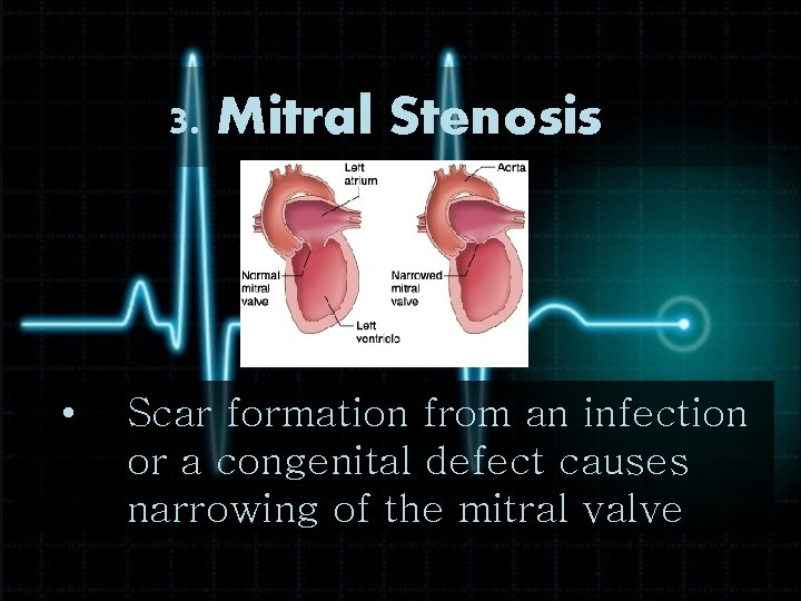 3. Mitral Stenosis • Scar formation from an infection or a congenital defect causes