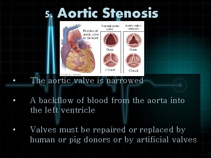 5. Aortic Stenosis • The aortic valve is narrowed • A backflow of blood