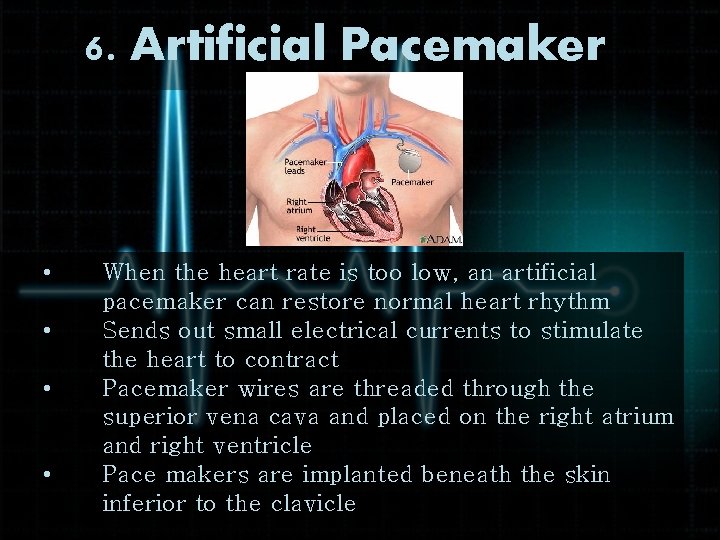 6. Artificial Pacemaker • • When the heart rate is too low, an artificial