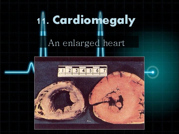 11. Cardiomegaly An enlarged heart 
