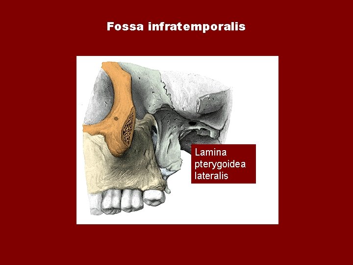 Fossa infratemporalis Lamina pterygoidea lateralis Fossa infratemporalis Lamina pterygoidea lateralis