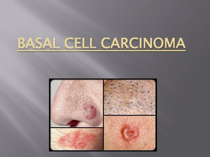 BASAL CELL CARCINOMA 