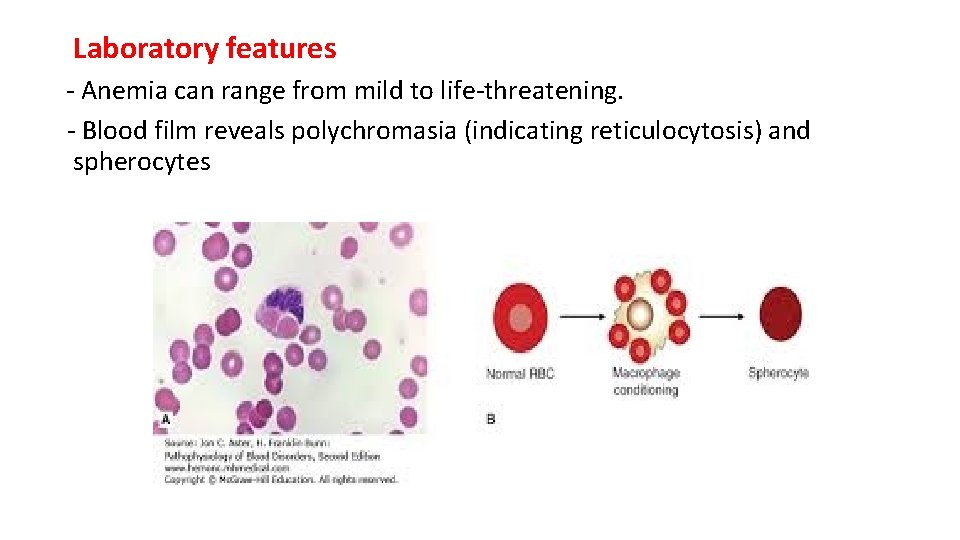 Laboratory features - Anemia can range from mild to life-threatening. - Blood film reveals