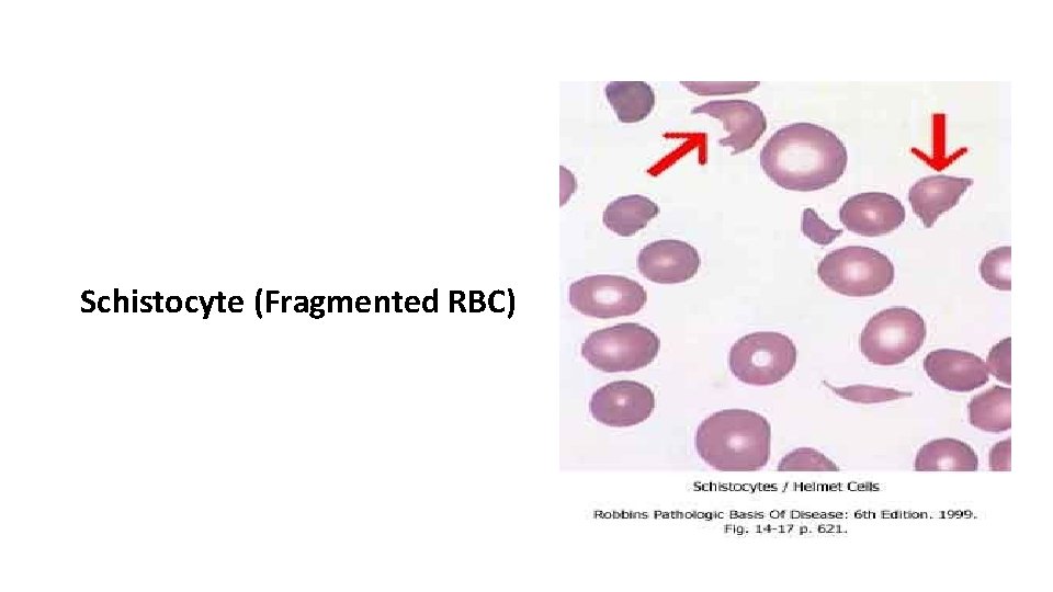Schistocyte (Fragmented RBC) 