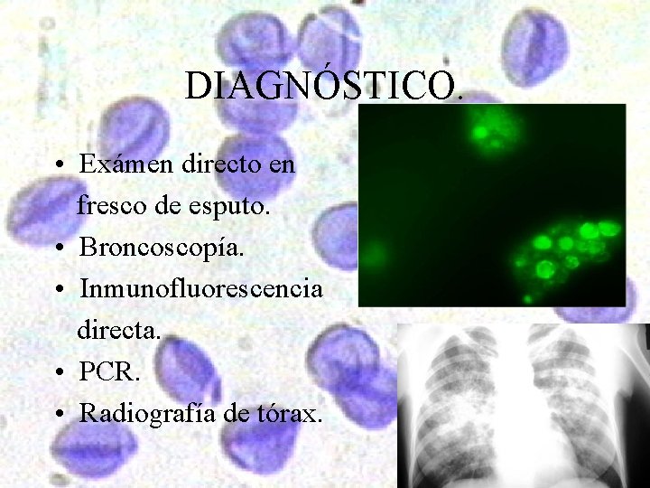 DIAGNÓSTICO. • Exámen directo en fresco de esputo. • Broncoscopía. • Inmunofluorescencia directa. •