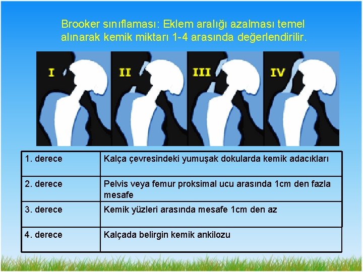 Brooker sınıflaması: Eklem aralığı azalması temel alınarak kemik miktarı 1 -4 arasında değerlendirilir. 1.