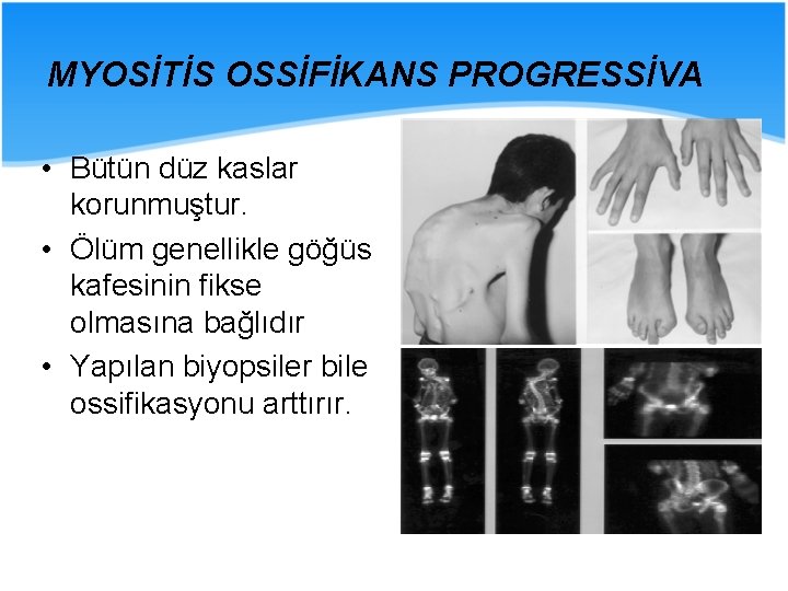 MYOSİTİS OSSİFİKANS PROGRESSİVA • Bütün düz kaslar korunmuştur. • Ölüm genellikle göğüs kafesinin fikse