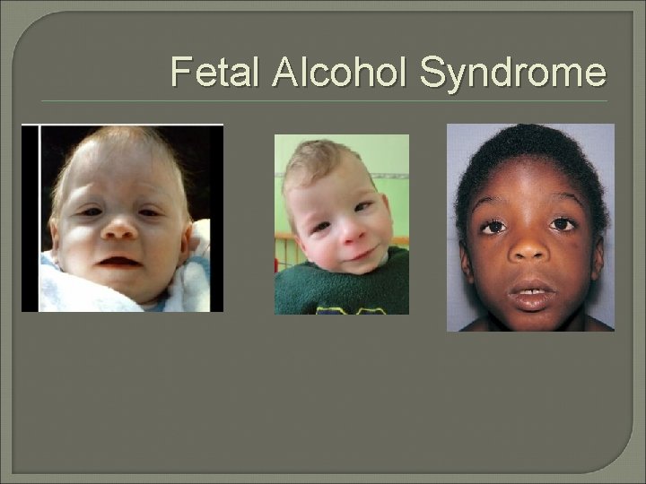 Fetal Alcohol Syndrome 