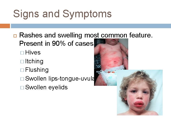 Signs and Symptoms Rashes and swelling most common feature. Present in 90% of cases.