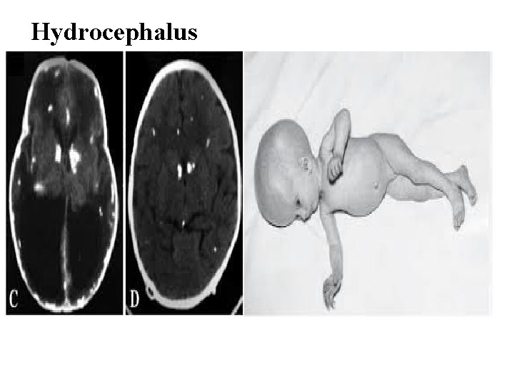 Hydrocephalus 