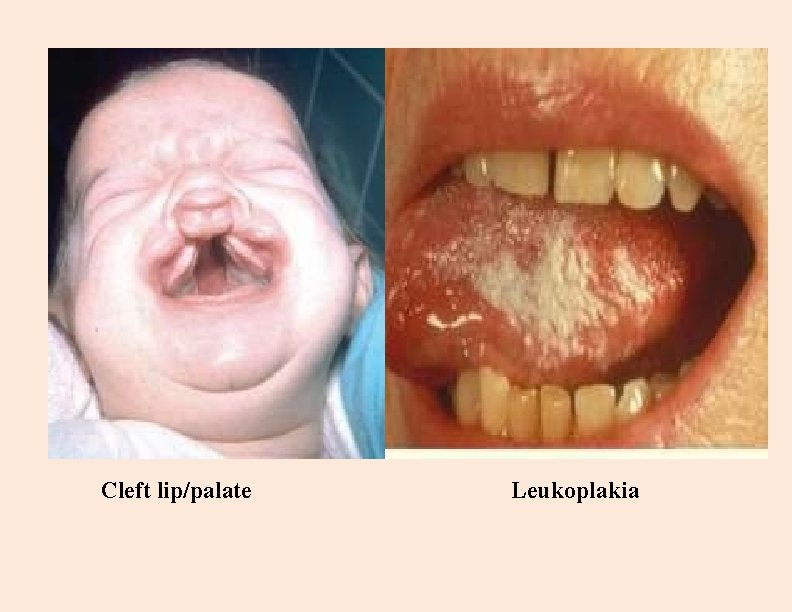 Cleft lip/palate Leukoplakia 