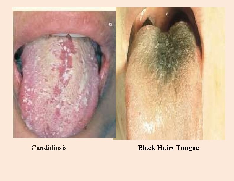Candidiasis Black Hairy Tongue 