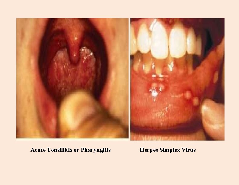 Acute Tonsillitis or Pharyngitis Herpes Simplex Virus 