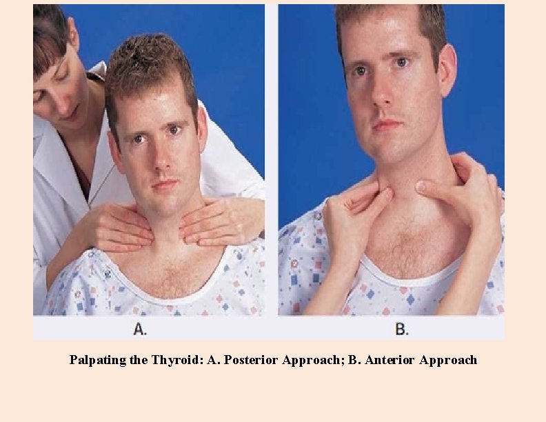 Palpating the Thyroid: A. Posterior Approach; B. Anterior Approach 