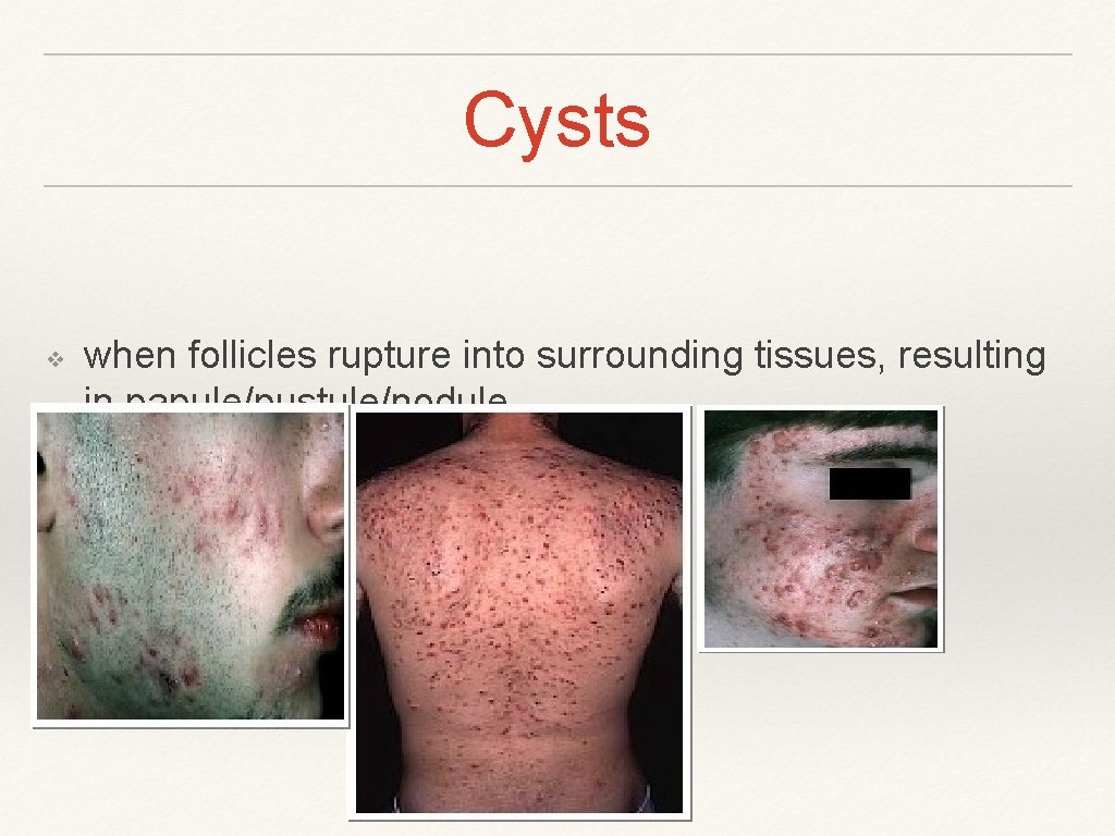 Cysts ❖ when follicles rupture into surrounding tissues, resulting in papule/pustule/nodule. 