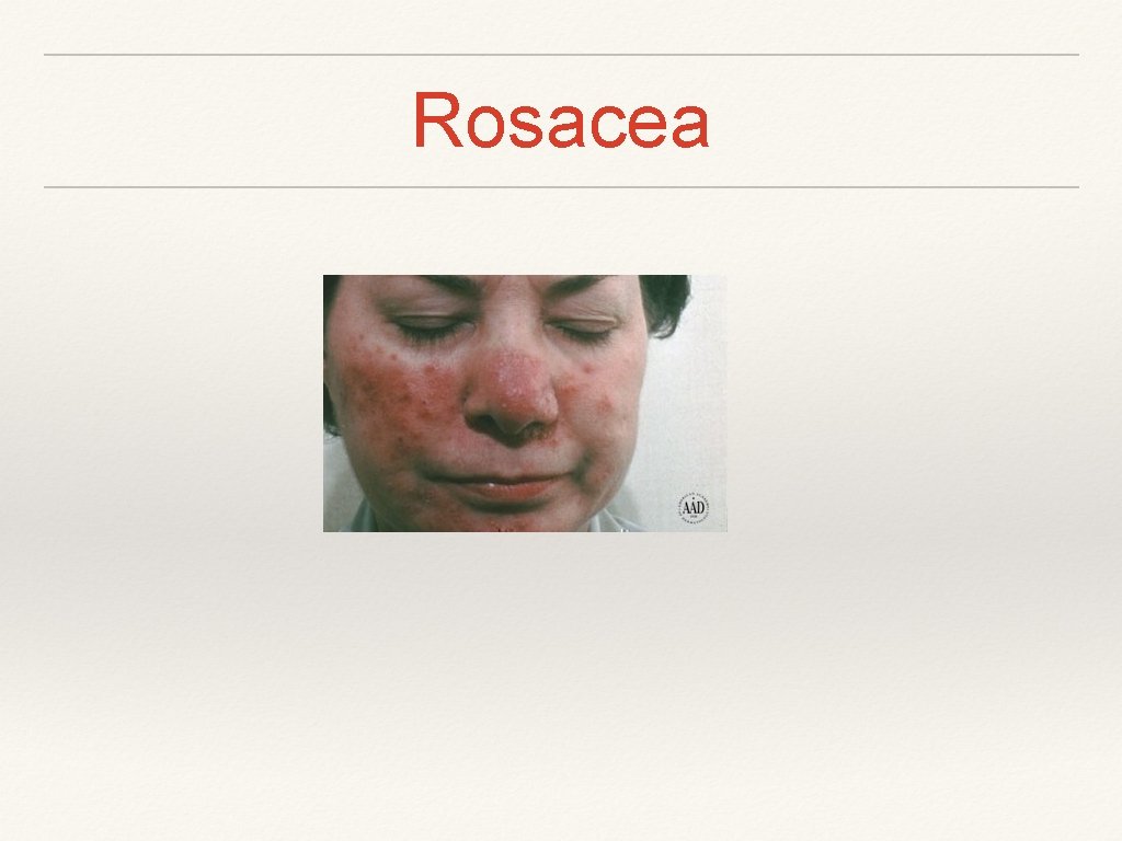 Rosacea 