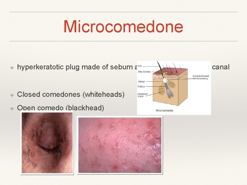 Microcomedone ❖ hyperkeratotic plug made of sebum and keratin in follicular canal ❖ Closed