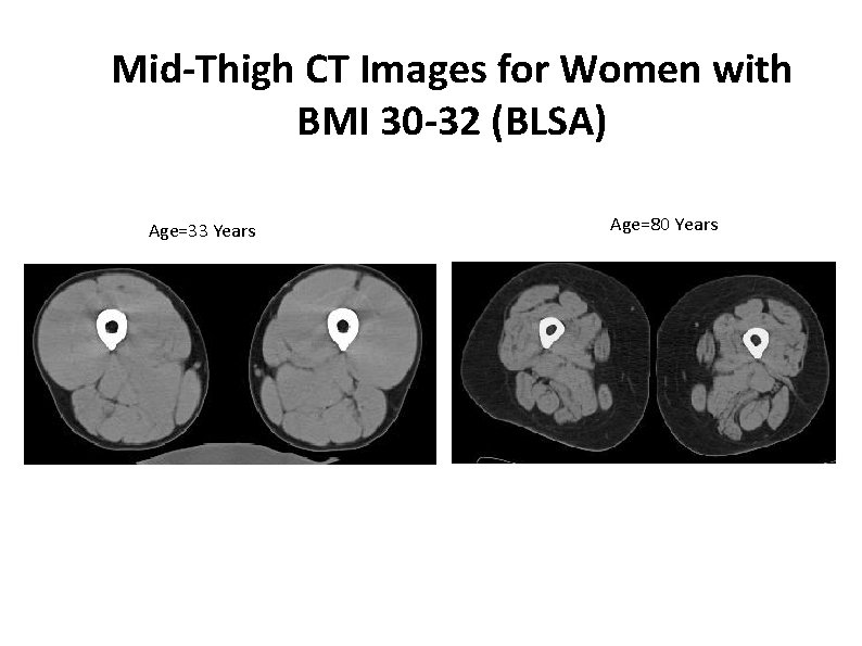Mid-Thigh CT Images for Women with BMI 30 -32 (BLSA) Age=33 Years Age=80 Years Mid-Thigh CT Images for Women with BMI 30 -32 (BLSA) Age=33 Years Age=80 Years
