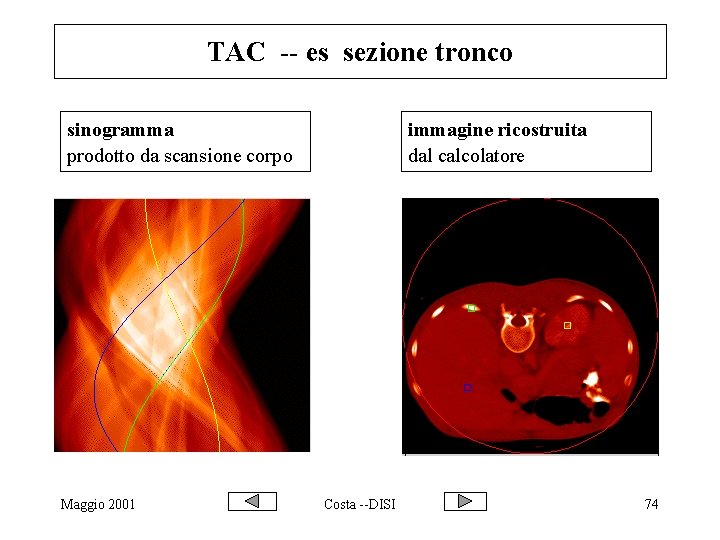 TAC -- es sezione tronco sinogramma prodotto da scansione corpo Maggio 2001 immagine ricostruita