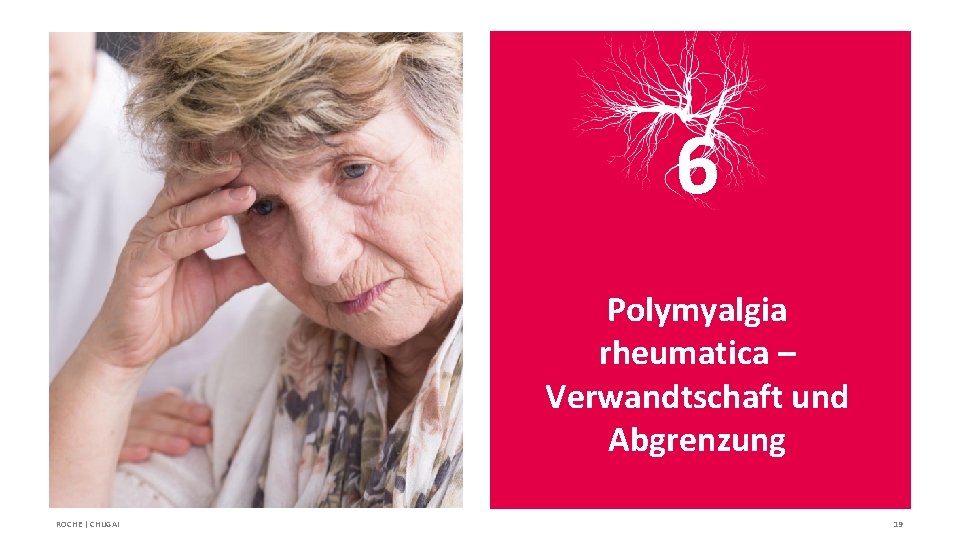 6 Polymyalgia rheumatica – Verwandtschaft und Abgrenzung ROCHE | CHUGAI 19 