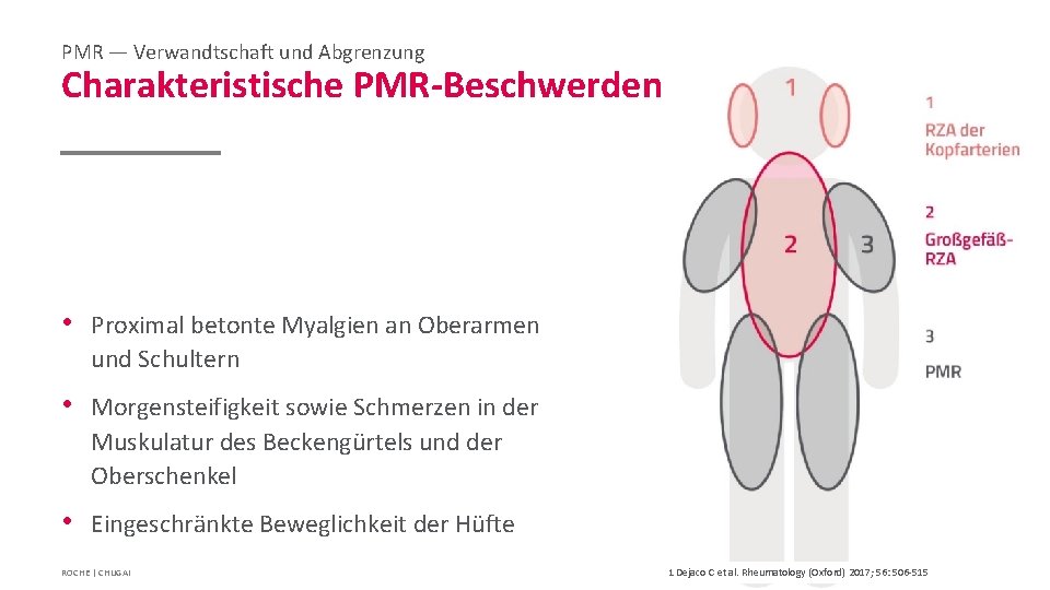 PMR — Verwandtschaft und Abgrenzung Charakteristische PMR-Beschwerden • Proximal betonte Myalgien an Oberarmen und