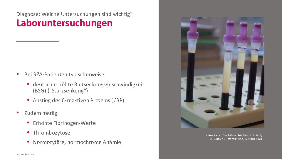 Diagnose: Welche Untersuchungen sind wichtig? Laboruntersuchungen • Bei RZA-Patienten typischerweise • deutlich erhöhte Blutsenkungsgeschwindigkeit